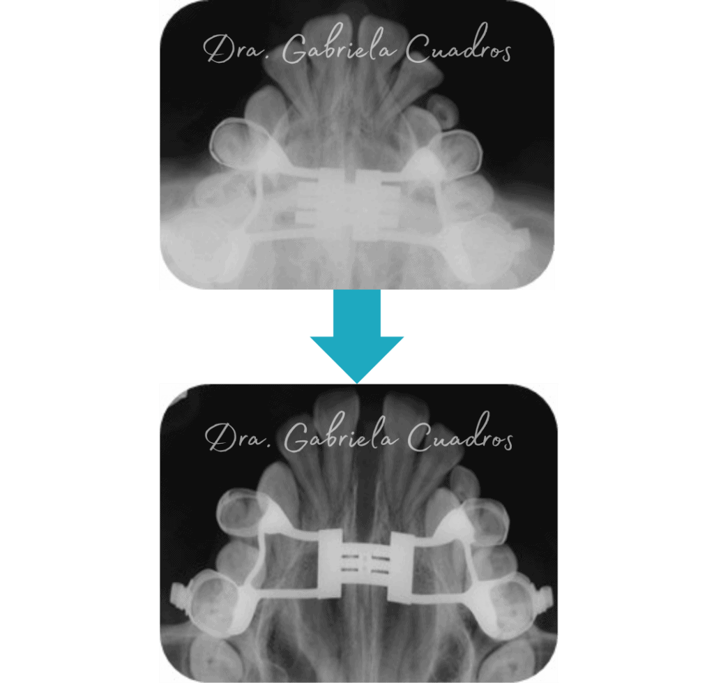 Ortodoncia en Lima - Clinica Alinea