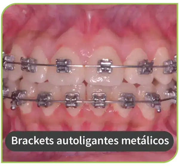 dentista especialista brackets autoligantes metalicos lima peru 2
