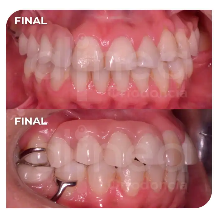 Especialista en ortodoncia preprotesica brackets en adultos protesis surco lima 4