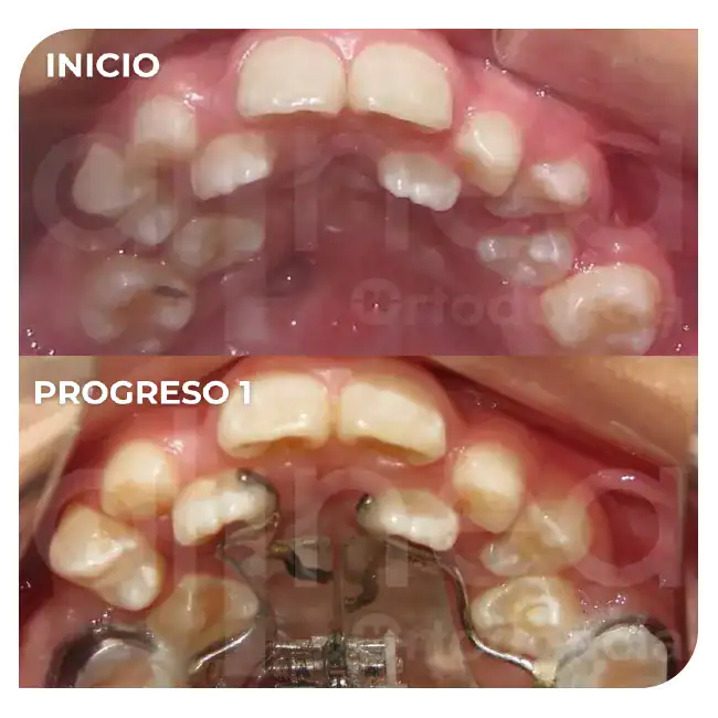 Ortodoncia en niños ortopedia maxilar brackets adolescentes labio leporino paladar fisurado surco lima 1
