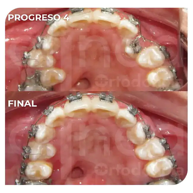 Ortodoncia en niños ortopedia maxilar brackets adolescentes labio leporino paladar fisurado surco lima 3