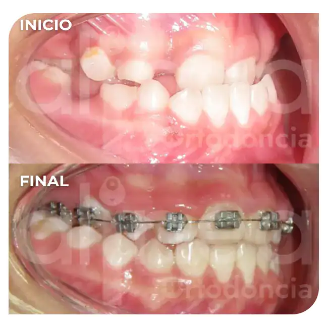 Ortodoncia en niños ortopedia maxilar brackets adolescentes labio leporino paladar fisurado surco lima 4