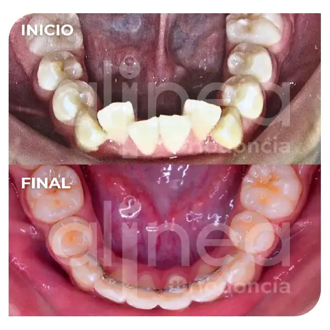 especialista en protrusion dental clase II 1 brackets dientes salidos inclinados hacia adelante 6