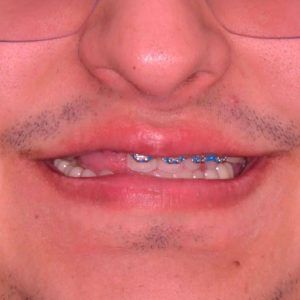 Me puedo poner brackets si me faltan 4 muelas