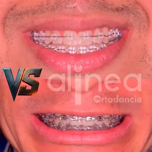 cual es mejor brackets metalicos o esteticos ortodoncista lima