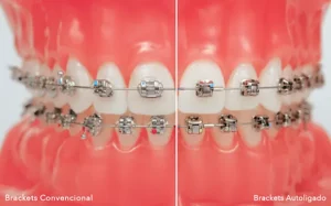 Cuál es mejor brackets autoligantes o convencionales Lima Peru