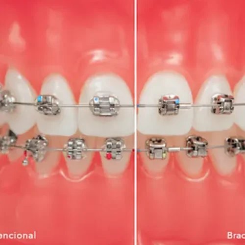 Cuál es mejor brackets autoligantes o convencionales Lima Peru