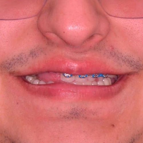 Me puedo poner brackets si me faltan 4 muelas