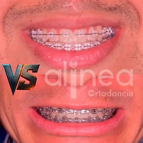 cual es mejor brackets metalicos o esteticos ortodoncista lima